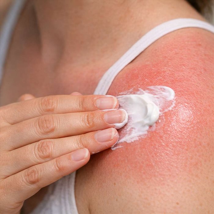 Apaiser l'Urticaire : Solutions et Conseils Pratiques